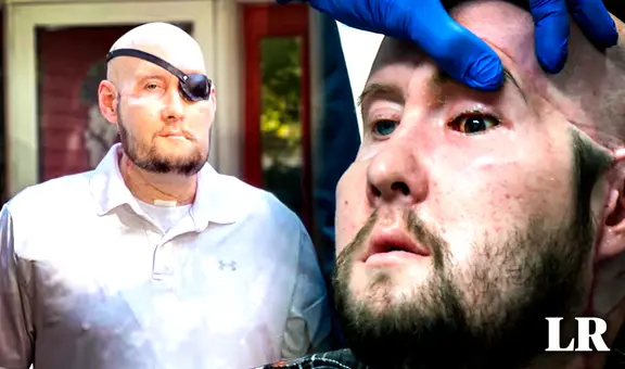 Médicos de EE. UU. logran realizar el primer trasplante de ojo en el mundo