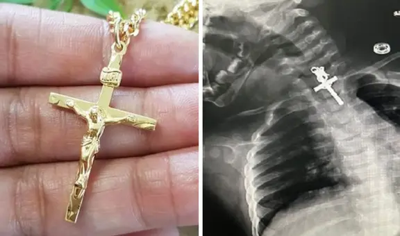 Bebé tenía un crucifijo alojado en su esófago: médicos de La Libertad la operaron con éxito