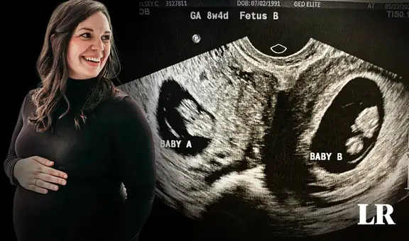 Embarazo insólito: mujer estadounidense tiene dos úteros y un feto en cada uno