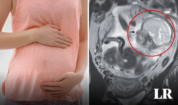 Fue al hospital por dolor de estómago y descubre que está embarazada: feto crecía en el intestino