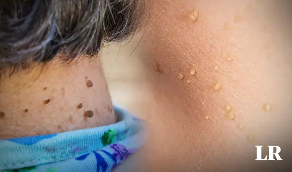¿Por qué me salen lunares de carne en el cuello o axilas y cómo eliminarlos? Especialistas lo explican