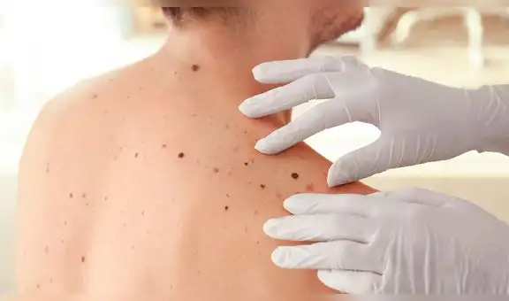 Lunares nuevos: por qué aparecen y cómo revisarlos