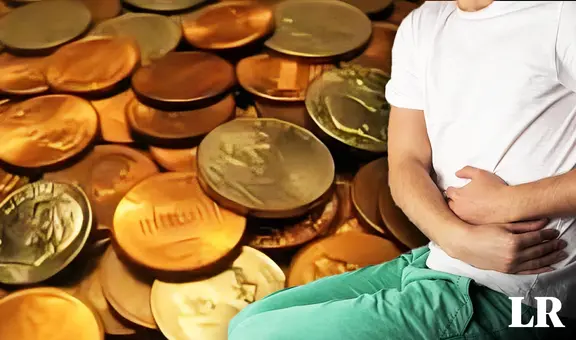 Hombre se salva de morir tras ingerir 39 monedas y 37 imanes: decía que "el zinc ayuda en el culturismo"