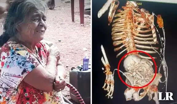 Mujer descubre que tenía un feto calcificado desde hace 56 años: murió tras operación