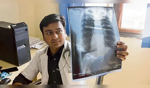 Cada año se reportan 30 mil casos de tuberculosis en el Perú