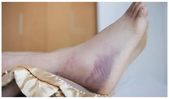 Día de la Hemofilia en el Perú: Más de 3 mil  afectados y solo el 30% cuenta con diagnóstico