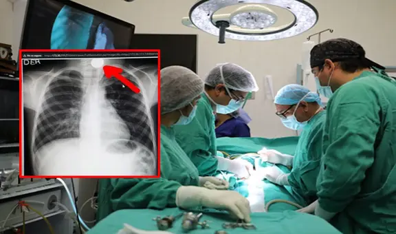 La Libertad: niño se traga moneda de 10 céntimos y doctores lo operan de emergencia