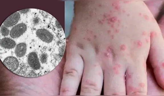 Minsa reporta primer caso de viruela del mono en Piura durante el 2024