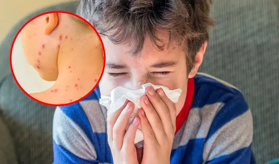 Perú en alerta por 'bacteria asesina' que alarmó a diversos países del mundo: ¿Cómo prevenirla y cuáles son sus síntomas?