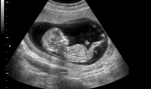 La bebé que nació ‘embarazada’ del feto de su hermano y tuvo que someterse a una cesárea a las horas de nacer