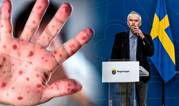 Reportan mpox en Suecia: es el primer caso de la nueva cepa de viruela del mono fuera de África
