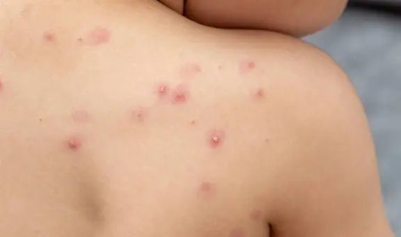 Síntomas de mpox y cómo se contagia: la enfermedad que ha causado más de 400 muertes en África este año