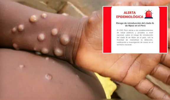 Minsa emite alerta epidemiológica a establecimientos de salud por nueva variante de la viruela del mono