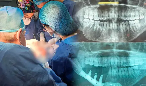 Realizan el primer implante de titanio en mandíbula a paciente con tumor en el Perú: "Si me crecía iba ser peor"