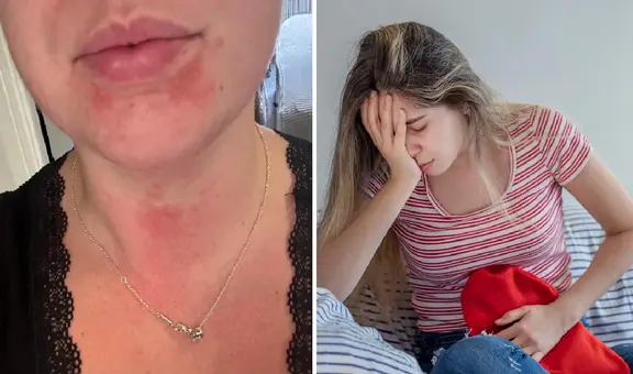 Mujer va al médico por extrañas erupciones en la piel y descubre que sería alérgica a su propia menstruación