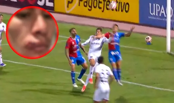 Así quedó el rostro del jugador de Melgar tras el codazo que recibió, por el que no cobraron penal