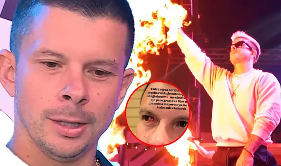 Mario Hart ALARMA al revelar que sufrió una FUERTE LESIÓN en el ojo: "Me clavé uno"