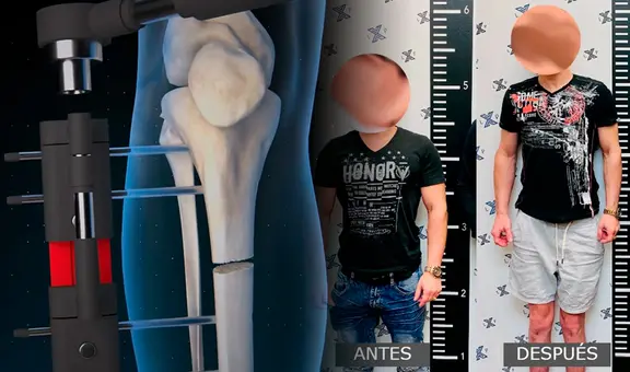 Así es la cirugía extrema para ser más alto: "Te rompen los huesos de las piernas para crecer hasta 15 centímetros"