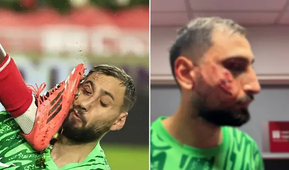 Donnarumma sufrió salvaje patada en el rostro y le pusieron 10 grapas: así quedó la cara del portero del PSG