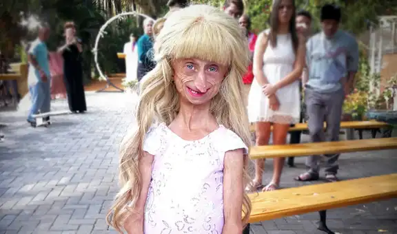 Muere influencer Beandri Booysen a los 19 años, padecía la enfermedad de envejecimiento extremo