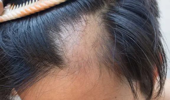 Investigadores de Harvard logran revertir la pérdida de cabello causada por la alopecia