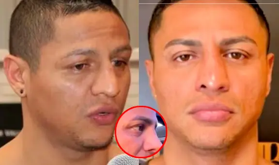 Jonathan Maicelo impacta a usuarios con radical cambio tras operación a la nariz: así luce ahora el boxeador