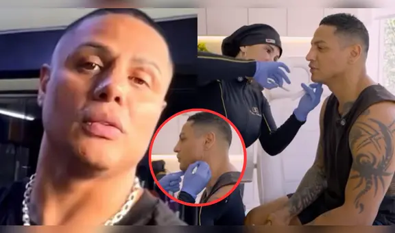 Jonathan Maicelo se habría sometido a otro retoque estético tras su operación de nariz: "Estoy pepa"