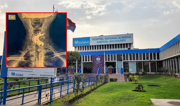 Médicos le salvaron la vida a adulto mayor que se tragó su dentadura postiza por accidente