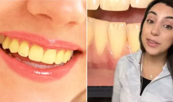 Dentista revela la verdadera razón detrás de los dientes amarillos, ¡aunque te cepilles diario!