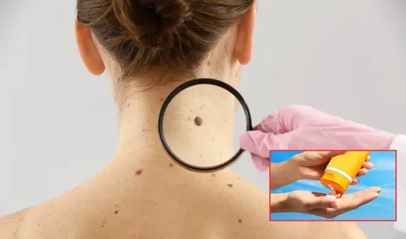 ¿Cómo proteger tu piel del sol y reducir el riesgo de cáncer? Dermatóloga peruana te brinda sus mejores recomendaciones