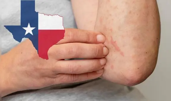 Confirman primera muerte por Sarampión en Texas: más de 120 casos de contagio confirmados