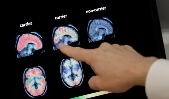 Científicos revelan las formas adecuadas que ayudarían a prevenir la demencia, según la Universidad de California