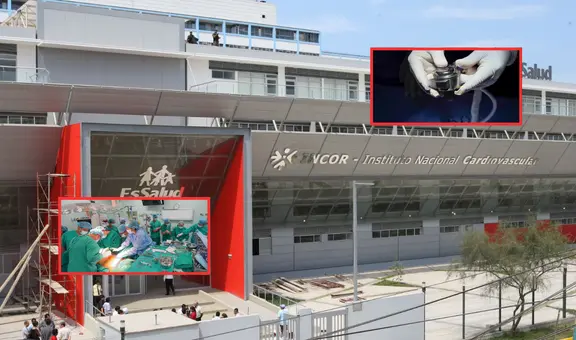 Histórico avance médico en Perú: EsSalud implanta por primera vez un corazón artificial portátil