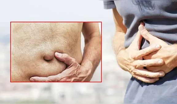 Hombre de EE. UU. demandó a su cuñado luego de que este le sellara el ombligo con pegamento: sufrió desgarros en la piel