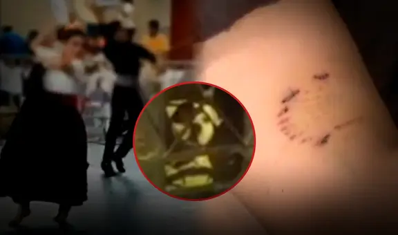 Bailaba marinera y ahora no puede moverse: perro ataca en la pierna a niña de 11 años en SMP