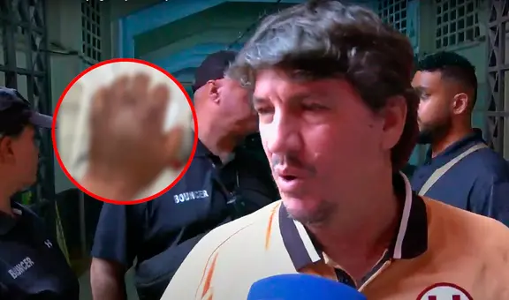 Jean Ferrari muestra fuerte imagen de cómo quedó la mano de Rodrigo Ureña tras el Universitario vs Boys: "Esto no se debe permitir"