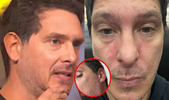 Cristian Rivero revela extraña reacción en su rostro que afecta su salud: “Los nervios existen”