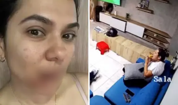 Mujer sufre graves quemaduras en el rostro tras la explosión de una empanada caliente en Medellín, Colombia