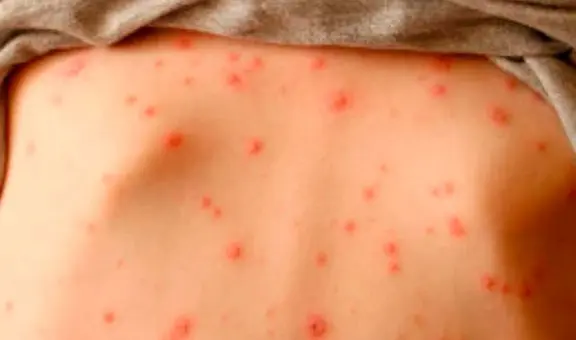 Sarampión en Nueva Jersey: autoridades de salud emiten advertencia por aparición de nuevos casos