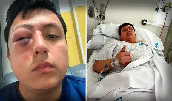 Joven peruano en España casi pierde un ojo tras agresión xenófoba en Madrid: "Nunca me pasó algo como esto"