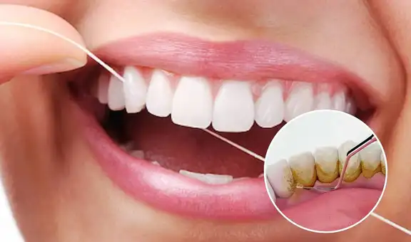 ¿Tienes sarro en los dientes? Este remedio casero puede ayudarte a eliminarlo rápidamente según dentistas