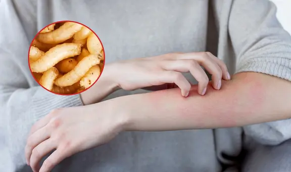 Confirman el primer caso humano de miasis por gusano barredor en México: ¿Cuáles son los síntomas?