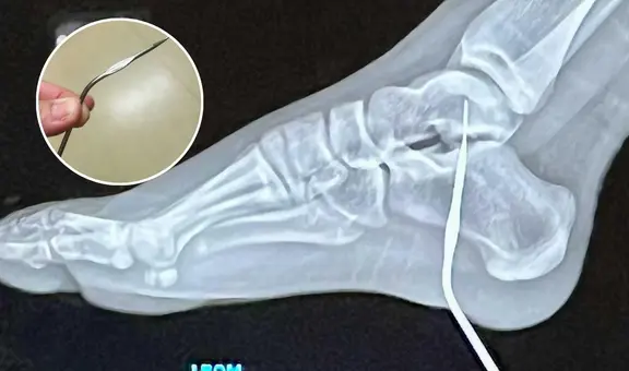 Niña sufre grave accidente al clavarse aguja de crochet de 10 cm en el pie: médicos en California "no podían creer lo que veían"