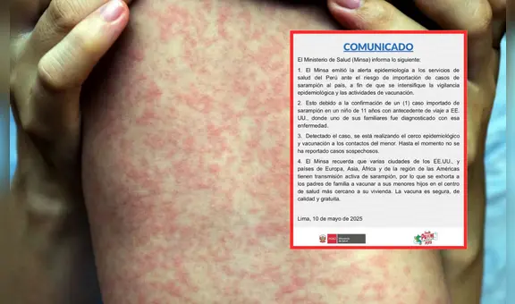 Minsa emite alerta epidemiológica por caso importado de sarampión desde Estados Unidos
