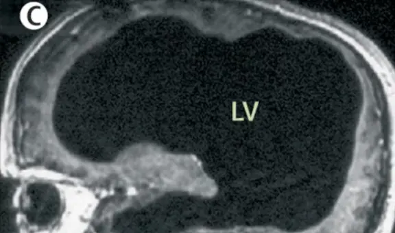 Hombre vive con el 10 % de su cerebro y lleva una vida normal: casado, con hijos y trabajo estable en Francia