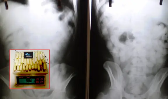 Peruano ingresó 90 cápsulas de cocaína en su cuerpo, pero terminó preso en Buenos Aires: la droga estaba valorizada en 1 millón de soles