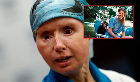 El impactante caso de Charla Nash, la mujer que fue atacada por un chimpancé que le desfiguró el rostro: arrancó labios, nariz y párpados