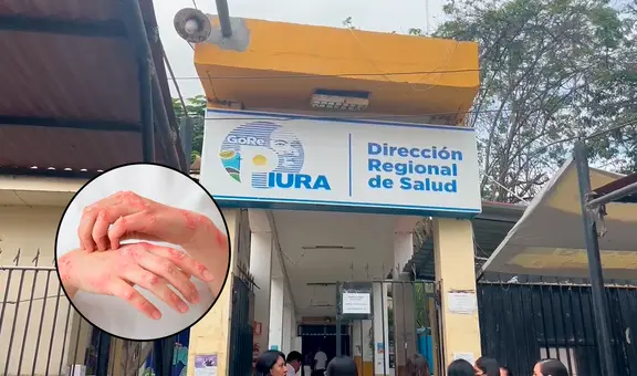 Lepra en Piura: Dirección Regional de Salud reporta el primer caso del 2025