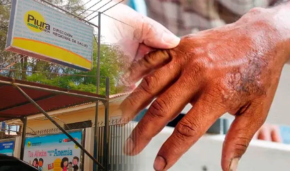 Primer caso de lepra importado en Piura: Diresa se pronuncia sobre paciente y advierte sobre la transmisión de la enfermedad