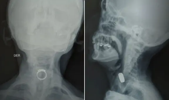 Mujer de 85 años comió un anillo mientras dormía: soñó que era caramelo y terminó internada en hospital de Lima